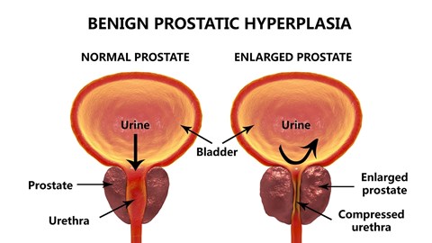 a prosztata fáj ami segít prostatitis bugyi kezelése